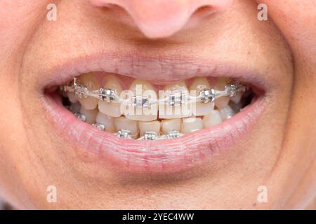 Bretelle in metallo sui denti della donna di mezza età indiana (britannica asiatica), solo bocca. Foto Stock