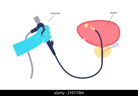 Illustrazione concettuale di una procedura di cistoscopia. Si tratta di una procedura utilizzata per diagnosticare, monitorare e trattare le condizioni che interessano la vescica e l'uretra. Foto Stock