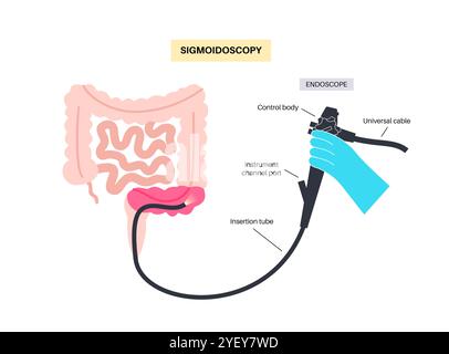 Illustrazione concettuale di una procedura sigmoidoscopica. Si tratta di un test diagnostico utilizzato per controllare il colon sigmoideo, la parte inferiore del colon o l'intestino crasso. La procedura può essere utilizzata per effettuare una biopsia e rimuovere polipi o emorroidi. È anche un test di screening per il cancro del colon e del retto. Foto Stock