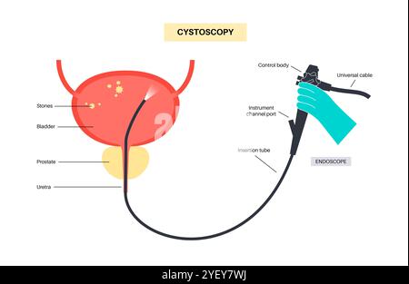 Illustrazione concettuale di una procedura di cistoscopia. Si tratta di una procedura utilizzata per diagnosticare, monitorare e trattare le condizioni che interessano la vescica e l'uretra. Foto Stock