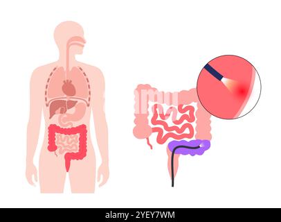 Illustrazione concettuale di una procedura sigmoidoscopica. Si tratta di un test diagnostico utilizzato per controllare il colon sigmoideo, la parte inferiore del colon o l'intestino crasso. La procedura può essere utilizzata per effettuare una biopsia e rimuovere polipi o emorroidi. È anche un test di screening per il cancro del colon e del retto. Foto Stock