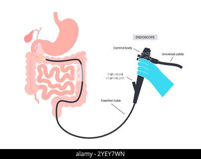 Illustrazione concettuale di una procedura di colonscopia. Questo è un esame dell'interno del vostro intestino crasso, che comprende il colon, il retto e l'ano. Può essere utilizzato per esplorare le possibili cause di dolore addominale, sanguinamento rettale, diarrea cronica e altri problemi gastrointestinali. Viene utilizzato anche per cercare possibili segni di cancro colorettale o polipi. Foto Stock