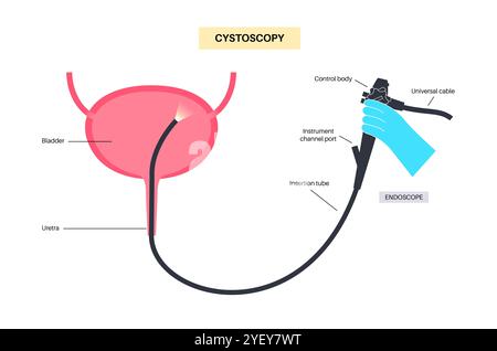 Illustrazione concettuale di una procedura di cistoscopia. Si tratta di una procedura utilizzata per diagnosticare, monitorare e trattare le condizioni che interessano la vescica e l'uretra. Foto Stock