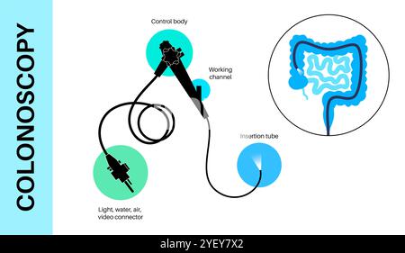 Illustrazione concettuale di una procedura di colonscopia. Questo è un esame dell'interno del vostro intestino crasso, che comprende il colon, il retto e l'ano. Può essere utilizzato per esplorare le possibili cause di dolore addominale, sanguinamento rettale, diarrea cronica e altri problemi gastrointestinali. Viene utilizzato anche per cercare possibili segni di cancro colorettale o polipi. Foto Stock