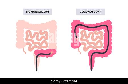 Illustrazione concettuale delle procedure di colonscopia e sigmoidoscopia. Entrambe le procedure cercano aree anomale del colon e del retto. Entrambi utilizzano un tubo sottile e flessibile con una fotocamera e una luce all'estremità per guardare il colon. Una colonscopia esamina l'intero colon, mentre una sigmoidoscopia esamina il colon sigmoideo. Foto Stock