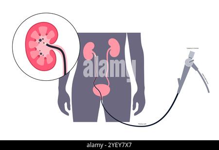 Illustrazione concettuale di una procedura ureteroscopica. Si tratta di una procedura eseguita per esaminare o trattare problemi nel tratto urinario, come i calcoli renali. Foto Stock