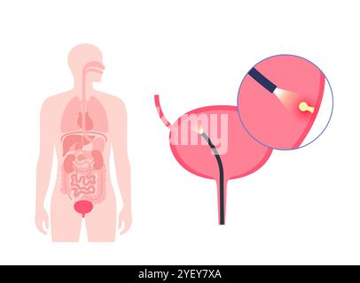 Illustrazione concettuale di una procedura di cistoscopia. Si tratta di una procedura utilizzata per diagnosticare, monitorare e trattare le condizioni che interessano la vescica e l'uretra. Foto Stock