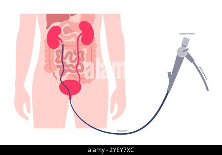 Illustrazione concettuale di una procedura ureteroscopica. Si tratta di una procedura eseguita per esaminare o trattare problemi nel tratto urinario, come i calcoli renali. Foto Stock
