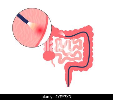 Illustrazione concettuale di una procedura di colonscopia. Questo è un esame dell'interno del vostro intestino crasso, che comprende il colon, il retto e l'ano. Può essere utilizzato per esplorare le possibili cause di dolore addominale, sanguinamento rettale, diarrea cronica e altri problemi gastrointestinali. Viene utilizzato anche per cercare possibili segni di cancro colorettale o polipi. Foto Stock