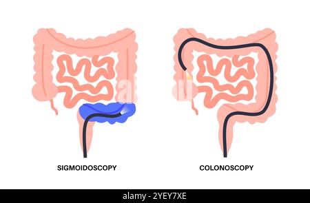Illustrazione concettuale delle procedure di colonscopia e sigmoidoscopia. Entrambe le procedure cercano aree anomale del colon e del retto. Entrambi utilizzano un tubo sottile e flessibile con una fotocamera e una luce all'estremità per guardare il colon. Una colonscopia esamina l'intero colon, mentre una sigmoidoscopia esamina il colon sigmoideo. Foto Stock