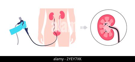 Illustrazione concettuale di una procedura ureteroscopica. Si tratta di una procedura eseguita per esaminare o trattare problemi nel tratto urinario, come i calcoli renali. Foto Stock