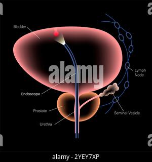 Illustrazione concettuale di una procedura di cistoscopia. Si tratta di una procedura utilizzata per diagnosticare, monitorare e trattare le condizioni che interessano la vescica e l'uretra. Foto Stock