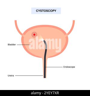 Illustrazione concettuale di una procedura di cistoscopia. Si tratta di una procedura utilizzata per diagnosticare, monitorare e trattare le condizioni che interessano la vescica e l'uretra. Foto Stock