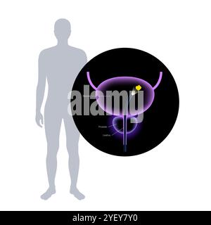 Illustrazione concettuale di una procedura di cistoscopia. Si tratta di una procedura utilizzata per diagnosticare, monitorare e trattare le condizioni che interessano la vescica e l'uretra. Foto Stock