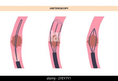 Illustrazione concettuale di una procedura ureteroscopica. Si tratta di una procedura eseguita per esaminare o trattare problemi nel tratto urinario, come i calcoli renali. Foto Stock