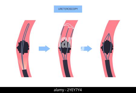Illustrazione concettuale di una procedura ureteroscopica. Si tratta di una procedura eseguita per esaminare o trattare problemi nel tratto urinario, come i calcoli renali. Foto Stock