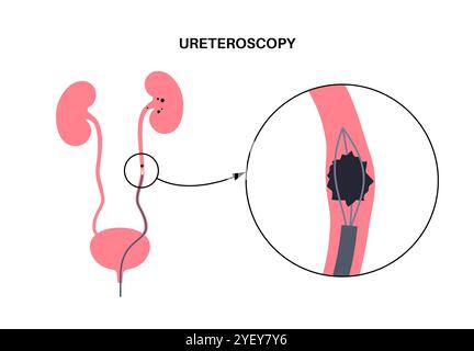 Illustrazione concettuale di una procedura ureteroscopica. Si tratta di una procedura eseguita per esaminare o trattare problemi nel tratto urinario, come i calcoli renali. Foto Stock