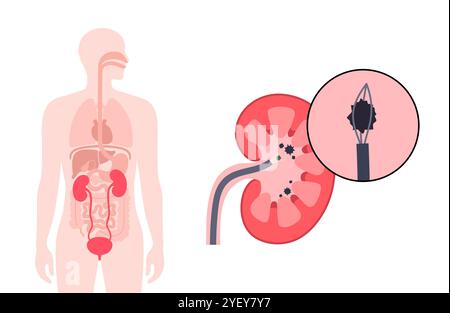 Illustrazione concettuale di una procedura ureteroscopica. Si tratta di una procedura eseguita per esaminare o trattare problemi nel tratto urinario, come i calcoli renali. Foto Stock
