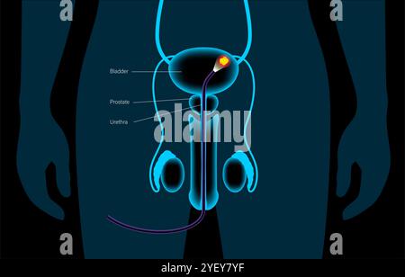 Illustrazione concettuale di una procedura di cistoscopia. Si tratta di una procedura utilizzata per diagnosticare, monitorare e trattare le condizioni che interessano la vescica e l'uretra. Foto Stock