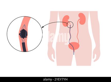 Illustrazione concettuale di una procedura ureteroscopica. Si tratta di una procedura eseguita per esaminare o trattare problemi nel tratto urinario, come i calcoli renali. Foto Stock