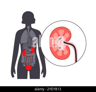 Illustrazione concettuale di una procedura ureteroscopica. Si tratta di una procedura eseguita per esaminare o trattare problemi nel tratto urinario, come i calcoli renali. Foto Stock