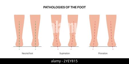 Illustrazione concettuale delle patologie del piede, tra cui neutro, supinazione e pronazione eccessiva. La pronazione descrive il modo in cui un piede rotola verso l'interno e distribuisce l'impatto del peso del corpo al momento dell'atterraggio. In caso di sovrapronazione, i piedi spostano eccessivamente l'impatto. Nella sottopronazione, nota anche come supinazione, i piedi non spostano l'impatto abbastanza lontano. Foto Stock