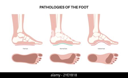 Illustrazione concettuale delle patologie del piede, comprese le condizioni dei piedi piatti, normali e cavi. Un piede piatto non ha un arco o un arco molto basso, mentre un piede cavo è caratterizzato da un arco eccessivo. Foto Stock