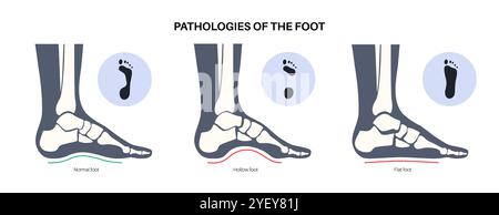 Illustrazione concettuale delle patologie del piede, comprese le condizioni dei piedi piatti, normali e cavi. Un piede piatto non ha un arco o un arco molto basso, mentre un piede cavo è caratterizzato da un arco eccessivo. Foto Stock