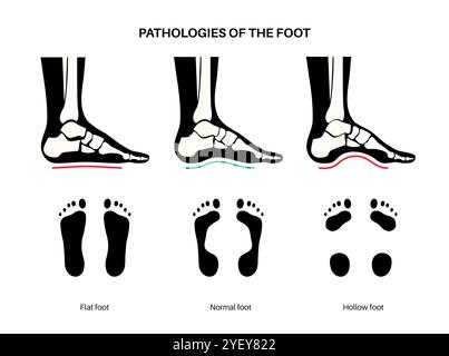 Illustrazione concettuale delle patologie del piede, comprese le condizioni dei piedi piatti, normali e cavi. Un piede piatto non ha un arco o un arco molto basso, mentre un piede cavo è caratterizzato da un arco eccessivo. Foto Stock