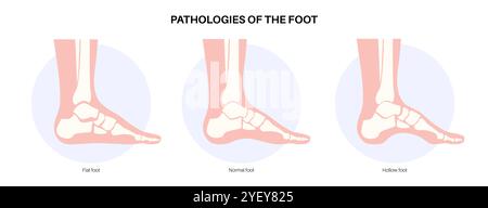 Illustrazione concettuale delle patologie del piede, comprese le condizioni dei piedi piatti, normali e cavi. Un piede piatto non ha un arco o un arco molto basso, mentre un piede cavo è caratterizzato da un arco eccessivo. Foto Stock