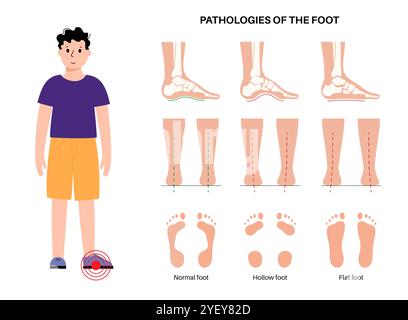 Illustrazione concettuale delle patologie del piede, comprese le condizioni dei piedi piatti, normali e cavi. Un piede piatto non ha un arco o un arco molto basso, mentre un piede cavo è caratterizzato da un arco eccessivo. Foto Stock