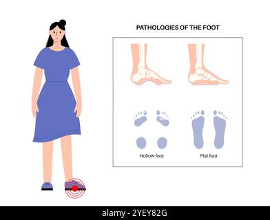 Illustrazione concettuale delle patologie del piede, comprese le condizioni dei piedi piatti e cavi. Un piede piatto non ha un arco o un arco molto basso, mentre un piede cavo è caratterizzato da un arco eccessivo. Foto Stock