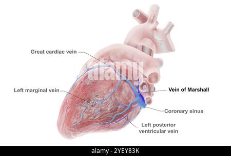 Illustrazione di vene coronarie con la vena di Marshall (blu scuro) evidenziata. La grande vena cardiaca si vede scorrere attraverso il ventricolo sinistro (camera inferiore) del cuore. La vena di Marshall, nota anche come vena obliqua atriale sinistra, è un residuo embrionale della vena cava superiore. Si ritiene che sia una fonte di trigger di fibrillazione atriale (AF), una frequenza cardiaca irregolare e spesso anormalmente veloce. Per una versione senza etichetta di questa immagine, vedere F043/3536. Foto Stock