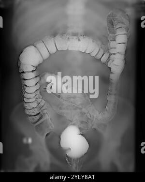 Radiografia frontale di un colon sano (intestino crasso). Il colon è la parte finale del tratto digerente, dove l'acqua viene assorbita dal cibo digerito e si formano feci solide. Un mezzo di contrasto al bario è stato introdotto nel colon per renderlo visibile sui raggi X. Foto Stock