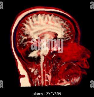 Risonanza magnetica colorata (MRI) scansione di un cervello umano sano. Foto Stock