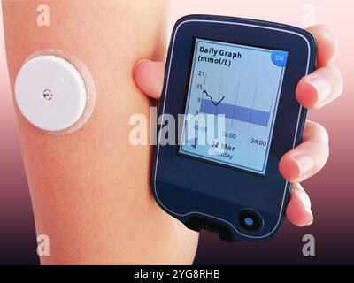 Primo piano del dispositivo per il monitoraggio continuo del glucosio nel sangue – CGM. Diabete di tipo 1. L'insulina dipende Foto Stock