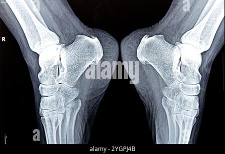 La radiografia normale del piede della paziente mostra lo sperone calcaneale del tallone, la formazione ossea sull'osso del tallone, la fascite plantare, un'infiammazione del fibroso Foto Stock