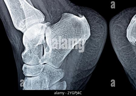 La radiografia normale del piede della paziente mostra lo sperone calcaneale del tallone, la formazione ossea sull'osso del tallone, la fascite plantare, un'infiammazione del fibroso Foto Stock