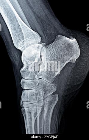 La radiografia normale del piede della paziente mostra lo sperone calcaneale del tallone, la formazione ossea sull'osso del tallone, la fascite plantare, un'infiammazione del fibroso Foto Stock