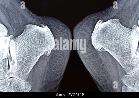 La radiografia normale del piede della paziente mostra lo sperone calcaneale del tallone, la formazione ossea sull'osso del tallone, la fascite plantare, un'infiammazione del fibroso Foto Stock