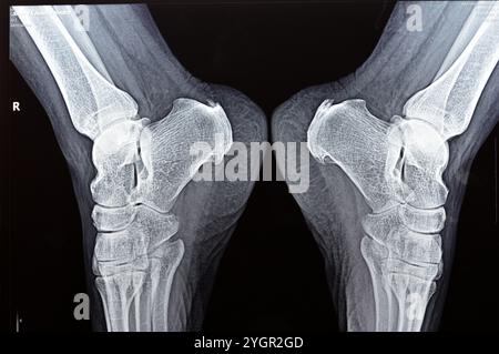 La radiografia normale del piede della paziente mostra lo sperone calcaneale del tallone, la formazione ossea sull'osso del tallone, la fascite plantare, un'infiammazione del fibroso Foto Stock