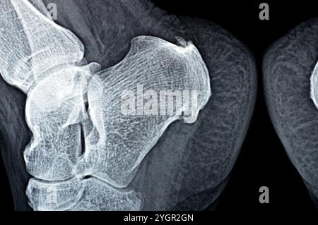 La radiografia normale del piede della paziente mostra lo sperone calcaneale del tallone, la formazione ossea sull'osso del tallone, la fascite plantare, un'infiammazione del fibroso Foto Stock