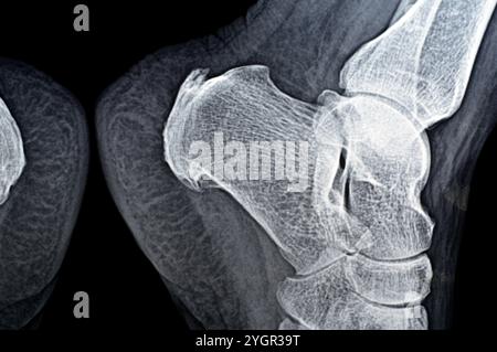 La radiografia normale del piede della paziente mostra lo sperone calcaneale del tallone, la formazione ossea sull'osso del tallone, la fascite plantare, un'infiammazione del fibroso Foto Stock