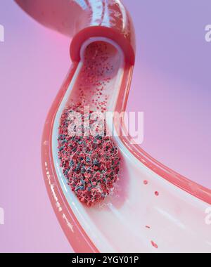 Immagine di un coagulo di sangue (trombo) in un vaso sanguigno. I coaguli si formano in risposta a malattie cardiovascolari o lesioni ai vasi sanguigni. Possono essere fatali se il flusso di sangue è bloccato a un organo vitale, come il cervello. Foto Stock