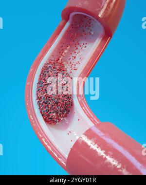 Immagine di un coagulo di sangue (trombo) in un vaso sanguigno. I coaguli si formano in risposta a malattie cardiovascolari o lesioni ai vasi sanguigni. Possono essere fatali se il flusso di sangue è bloccato a un organo vitale, come il cervello. Foto Stock