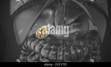 Calcoli biliari depositati nei dotti biliari o cistifellari Foto Stock