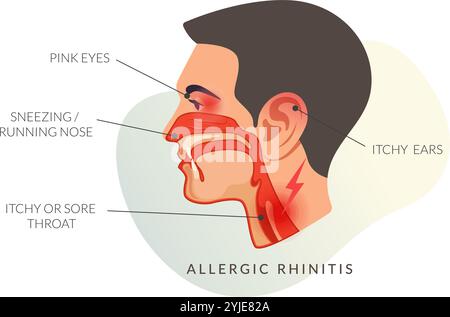 Sintomi della rinite allergica - starnuti - naso in esecuzione - Stock Illustration as EPS 10 file Illustrazione Vettoriale