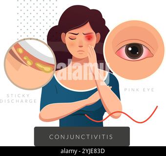 Congiuntivite - occhio rosa ed eccessiva scarica appiccicosa dall'occhio umano - illustrazione di scorta come file EPS 10 Illustrazione Vettoriale