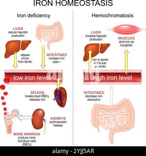 Omeostasi di ferro. Emocromatosi e anemia da carenza di ferro. Livelli normali di ferro nel sangue. Poster vettoriale Illustrazione Vettoriale