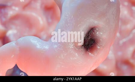 Cancro allo stomaco. Stadi crescita tumorale nell'apparato digerente, anatomia dell'ulcera peptica, cellula di attacco del cancro. concetto di malattia gastrica. sintomi, può maligno Foto Stock